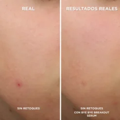 BYE BYE BREAKOUT SERUM